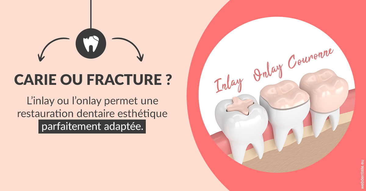 https://www.cabinet-dentaire-drlottin-drmagniez.fr/T2 2023 - Carie ou fracture 2
