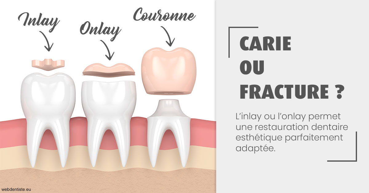 https://www.cabinet-dentaire-drlottin-drmagniez.fr/T2 2023 - Carie ou fracture 1