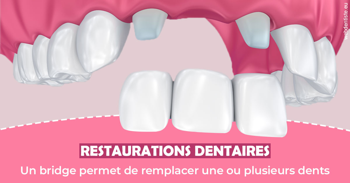 https://www.cabinet-dentaire-drlottin-drmagniez.fr/Bridge remplacer dents 2
