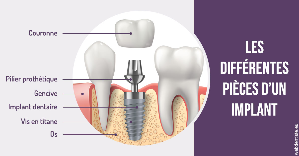 https://www.cabinet-dentaire-drlottin-drmagniez.fr/Les différentes pièces d’un implant 2