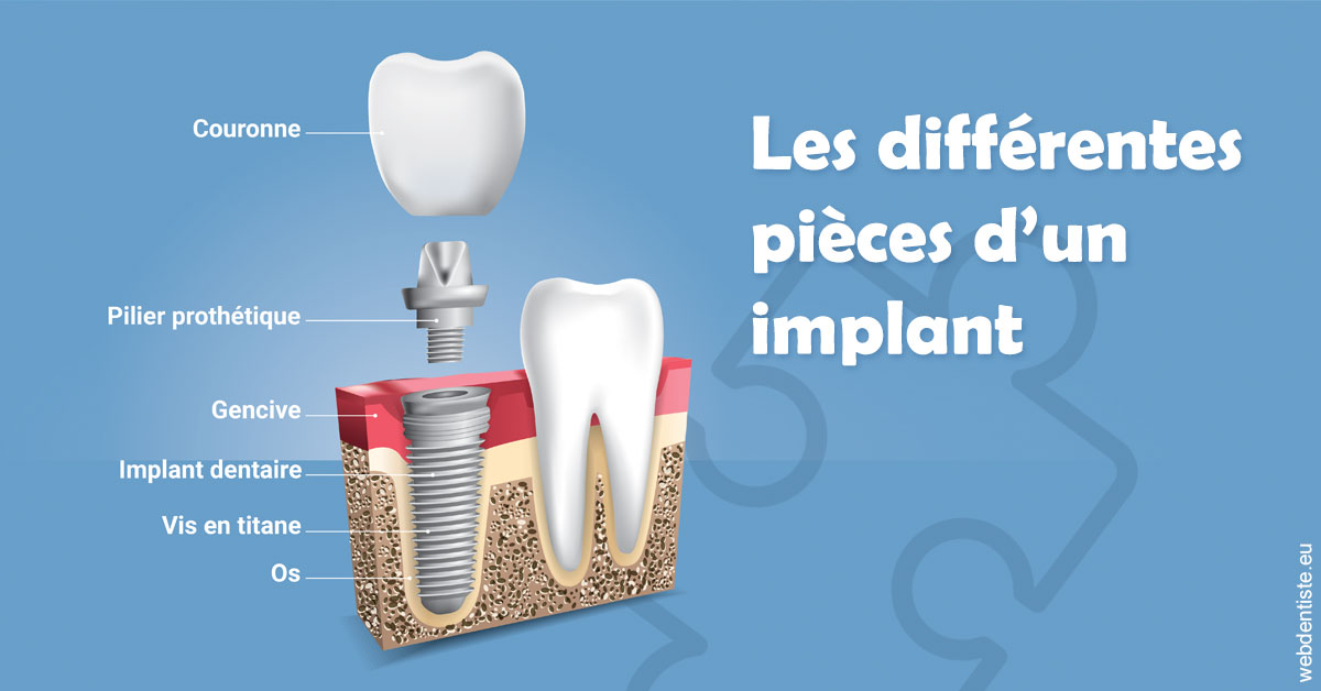 https://www.cabinet-dentaire-drlottin-drmagniez.fr/Les différentes pièces d’un implant 1